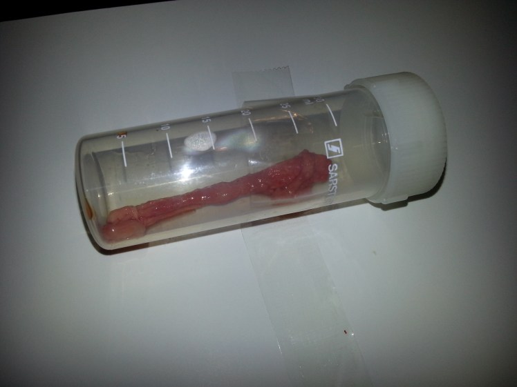 Griffelbenet som opererades bort